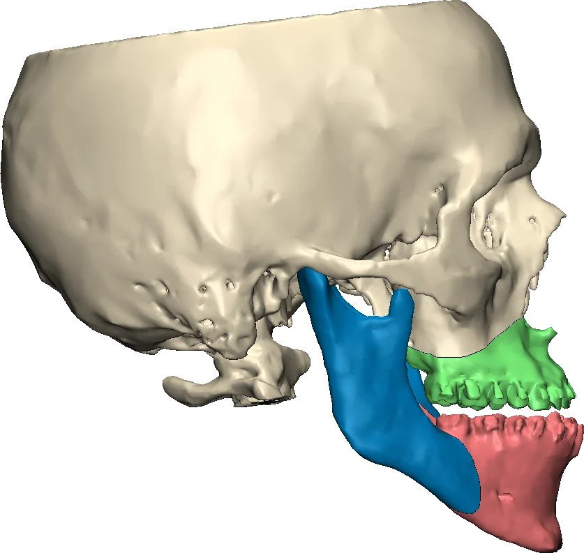 Cirugía ortognática: Planificación 3D de osteotomías