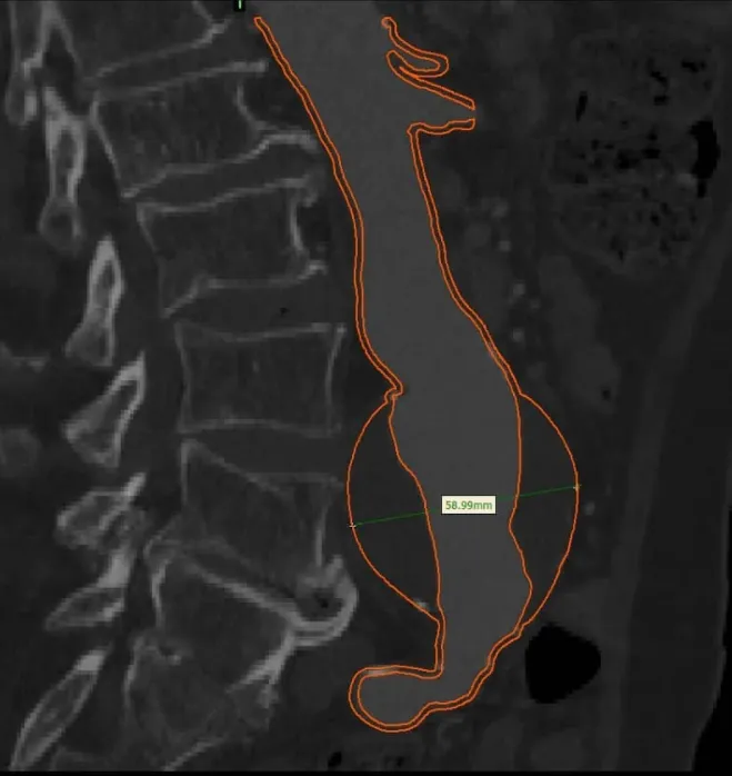 Tomografía sagital con la aorta segmentada